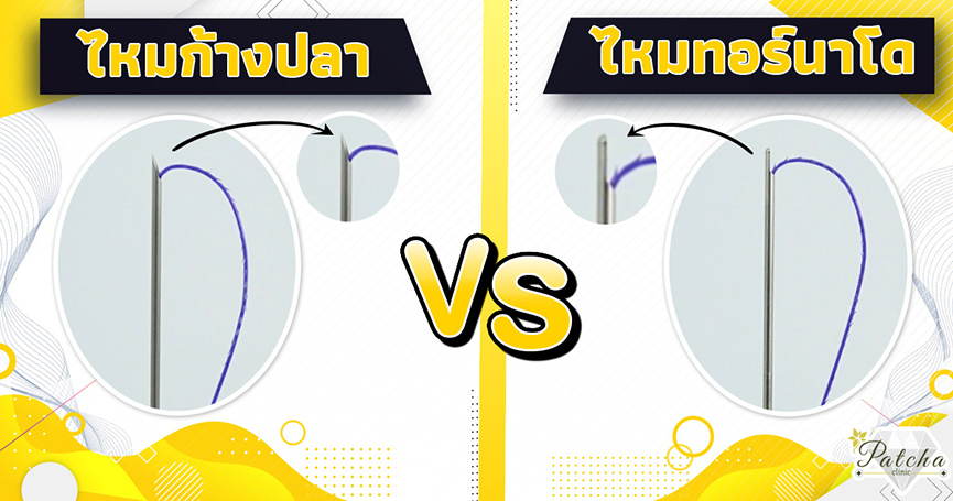 ไหมก้างปลาหรือไหมทอร์นาโด