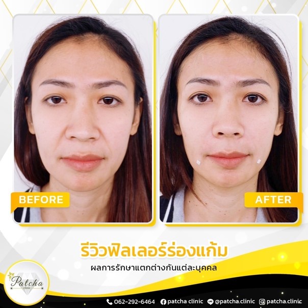 รีวิวร่องแก้ม