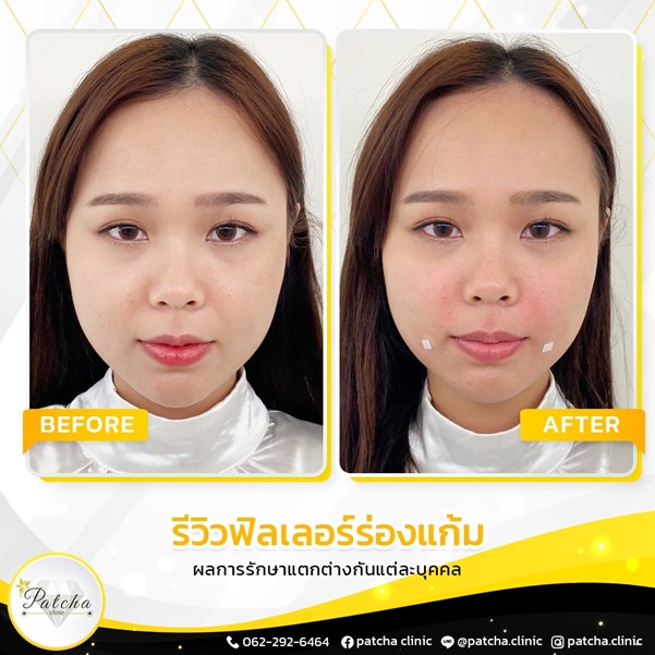 รีวิวหลังฉีดร่องแก้ม