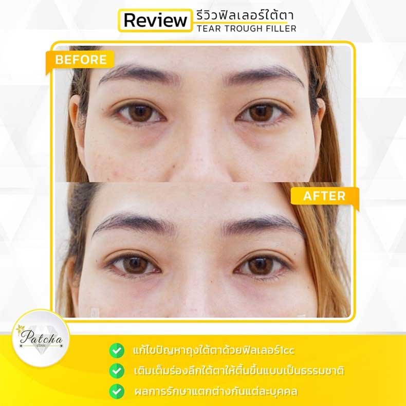 ฟิลเลอร์ใต้ตา