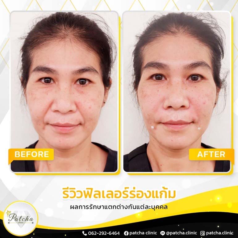 ฟิลเลอร์ร่องแก้ม