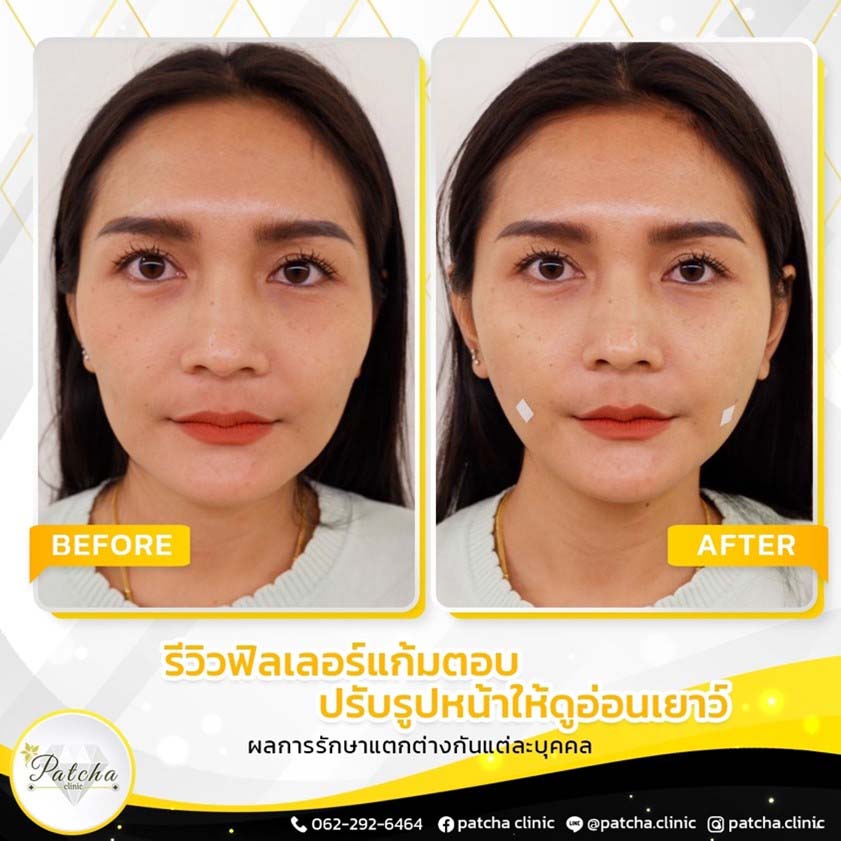 ฟิลเลอร์แก้มตอบ