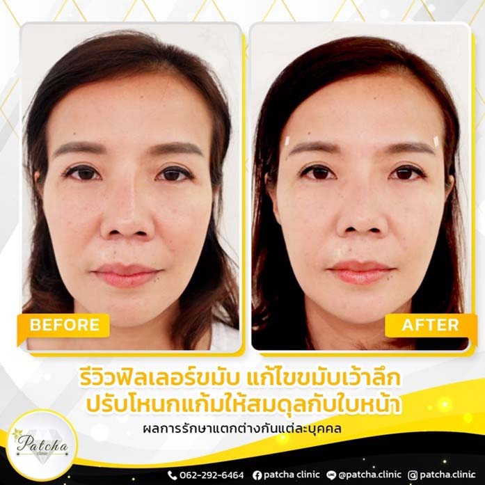 ฟิลเลอร์ขมับ