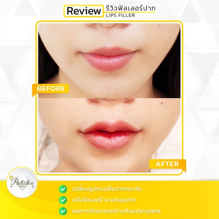 ฟิลเลอร์ปาก