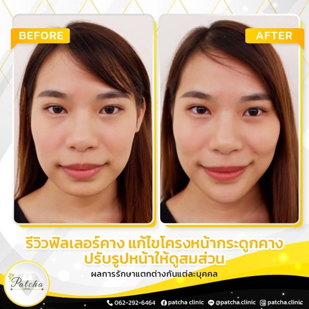 ฟิลเลอร์คาง