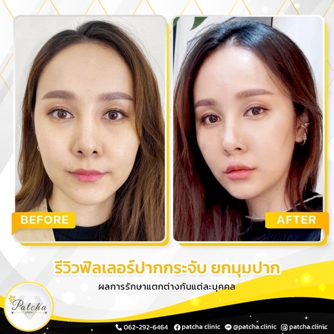 รีวิวฟิลเลอร์ปาก