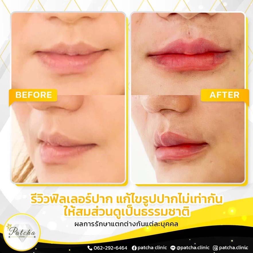รีวิวฉีดปาก