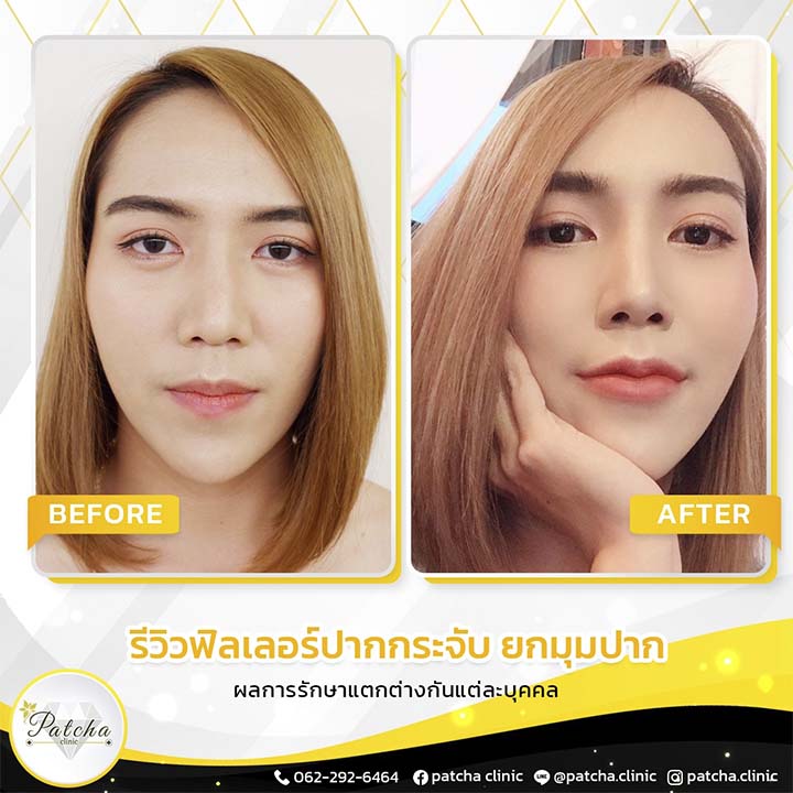 รีวิวปากกระจับ