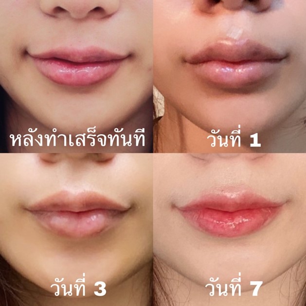 ผลลัพธ์ฉีดปาก