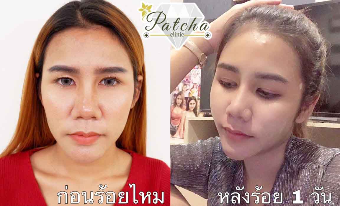 รีวิวร้อยไหม 1 วัน