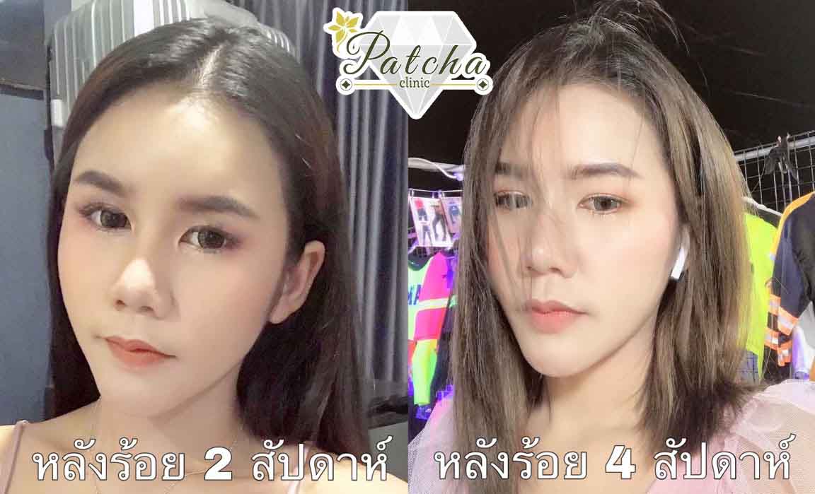 รีวิวหลังร้อยไหม 4 สัปดาห์