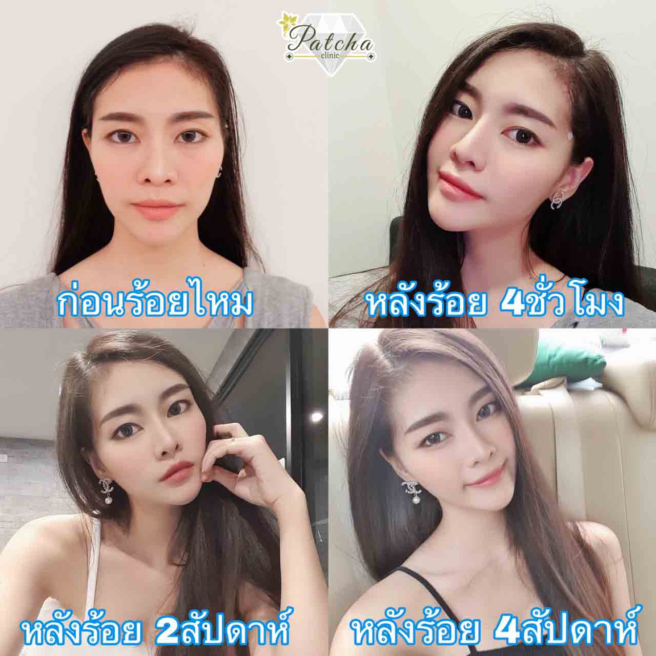 รีวิวร้อยไหม 4 สัปดาห์