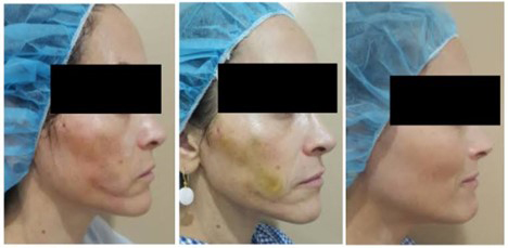 ผลข้างเคียงหลังการร้อยไหม