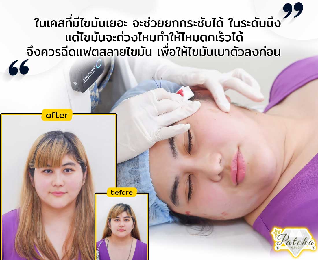 ร้อยไหมคนไข้ที่มีไขมันเยอะ