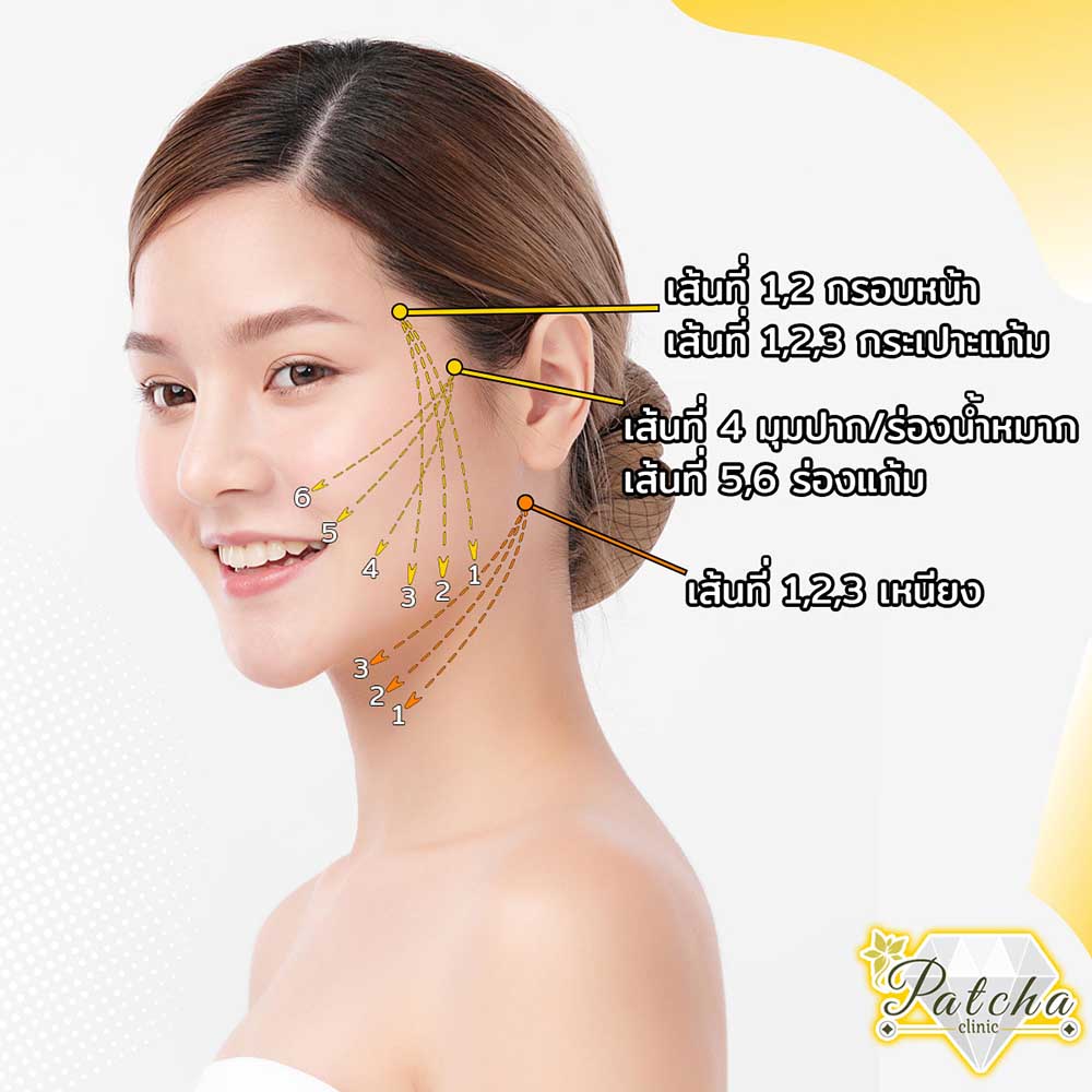 แนวการร้อยไหม