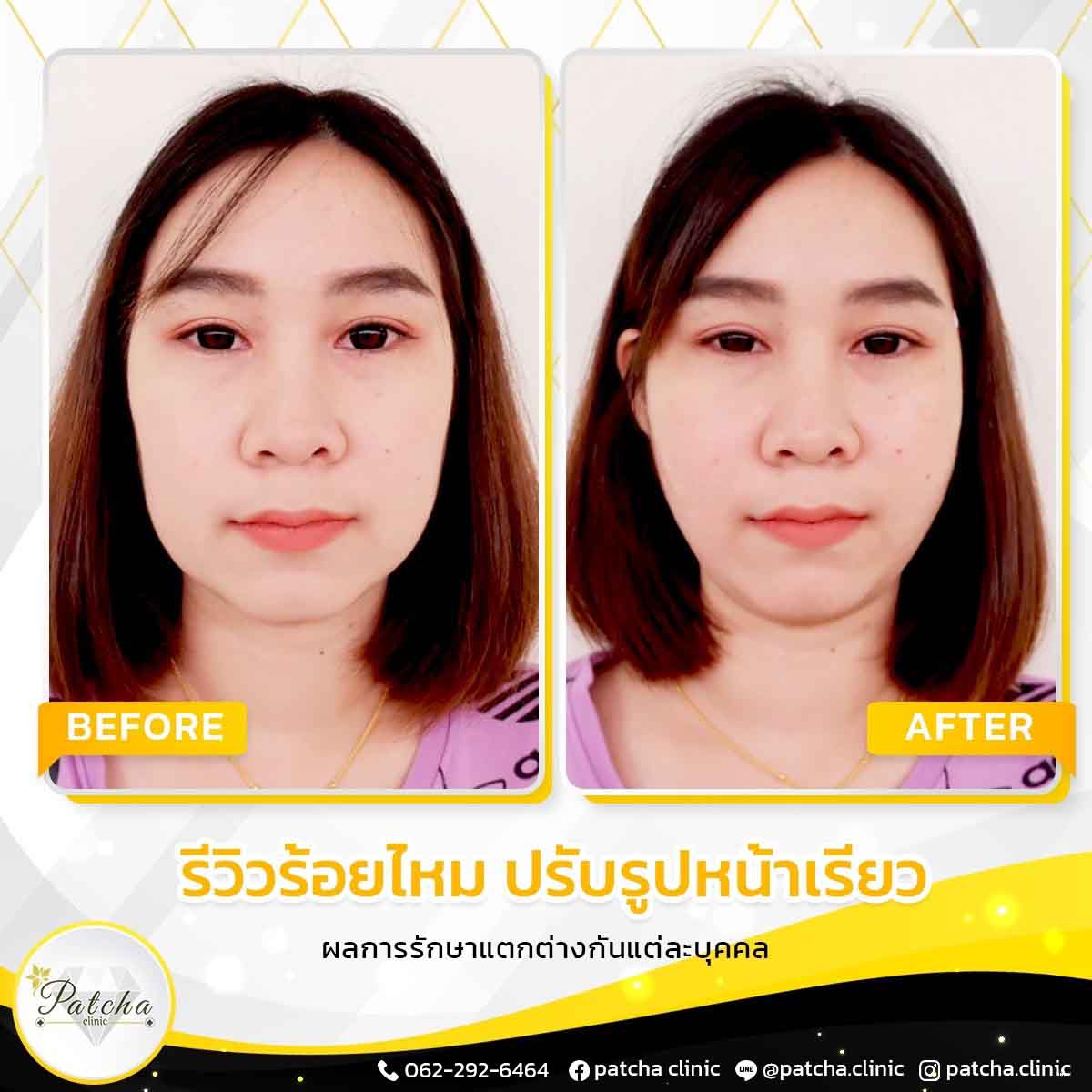 รีวิวไหมทอร์นาโด