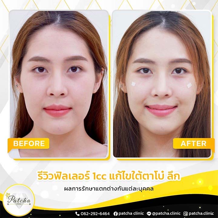 รีวิวเติมใต้ตา