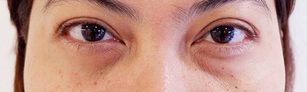 ใต้ตาโบ๋