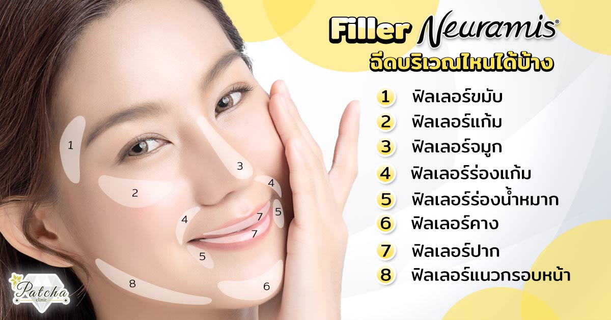 ฉีดฟิลเลอร์ตรงไหน