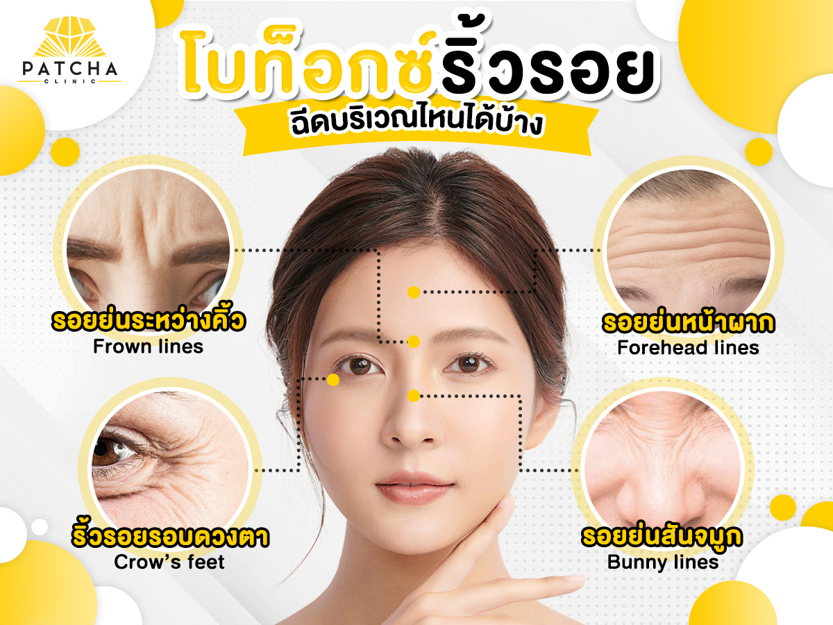 โบท็อกซ์ริ้วรอย