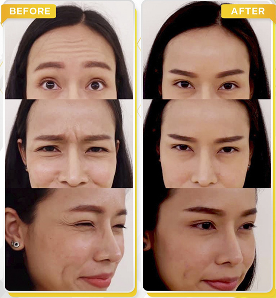 รีวิวโบท็อกซ์ลดริ้วรอย