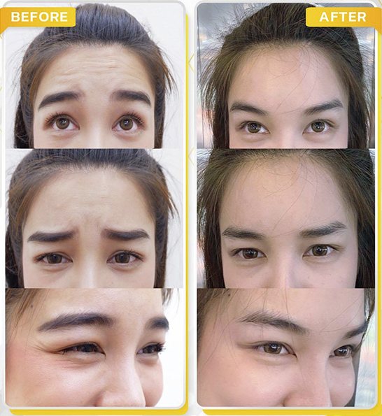 รีวิวโบท็อกซ์ลดริ้วรอย